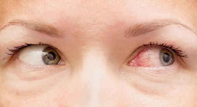 irritated eyes worry
